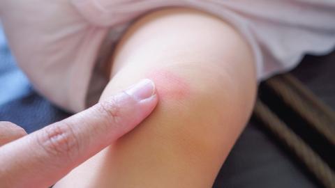 Behandlung einer Wunde mit Manuka Lind Salbe